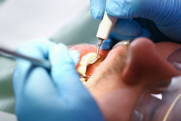 Best Emergency Treatment for Dental Infections or Abscesses in Sparks, GA